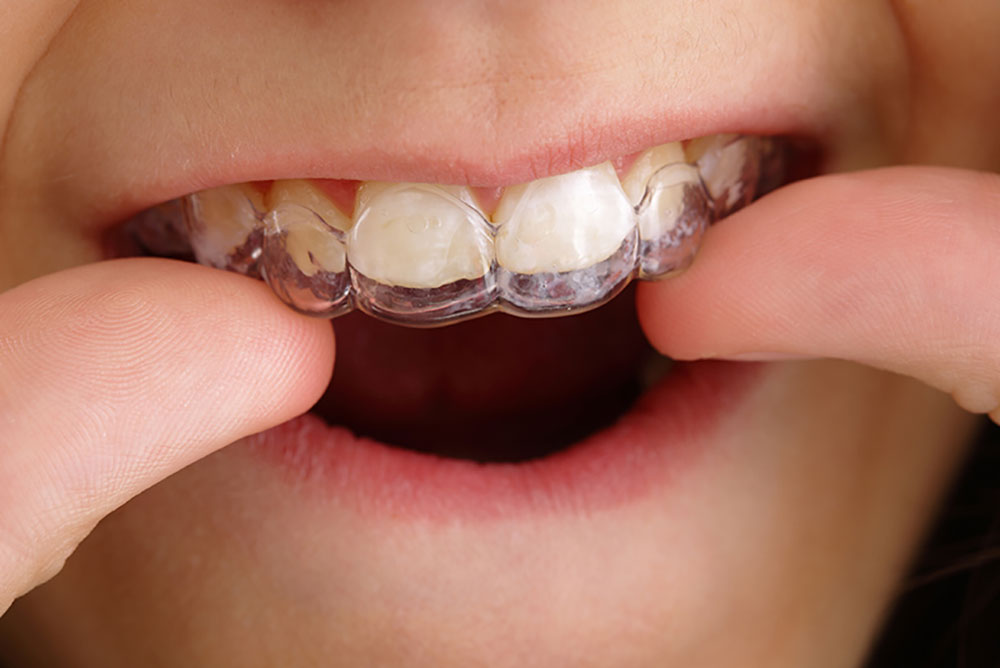 インビザラインファースト