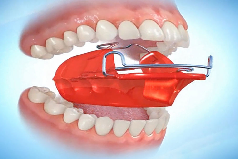 バイオネーター