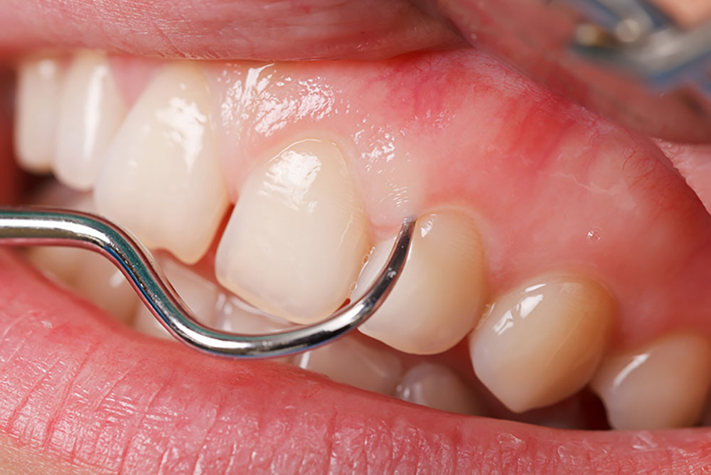 インプラント歯周炎に注意