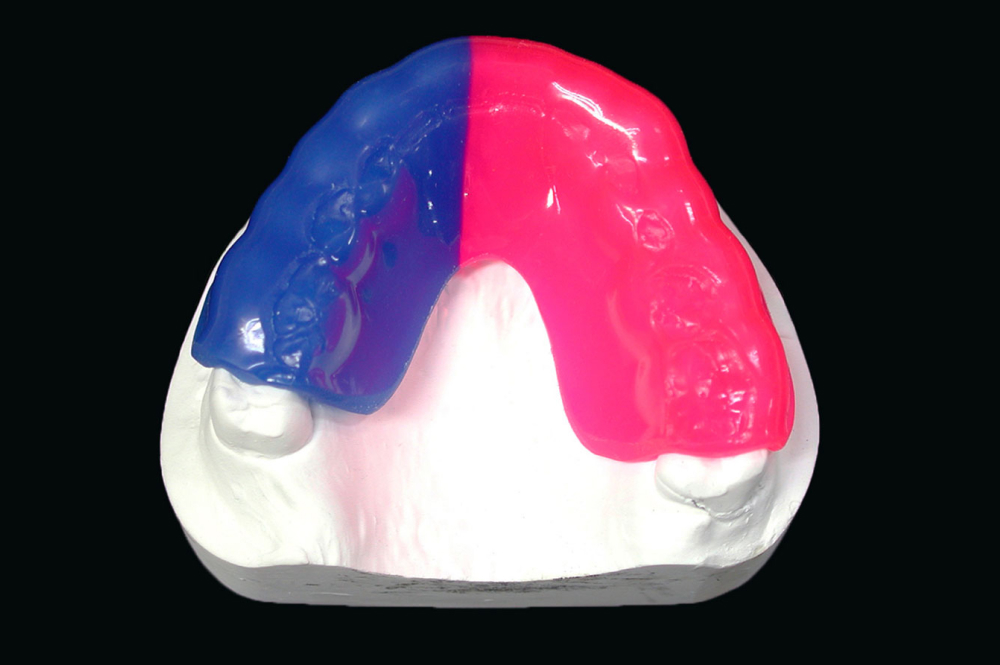 スポーツマウスガード