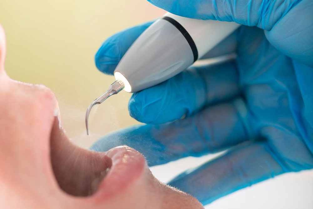 歯石除去（スケーリング）